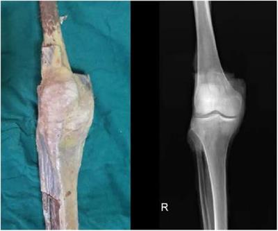 Femoral–tibial contact stresses on fixed rotational femur models